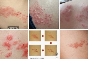 너무 아픈 대상포진…스트레스와 수면 부족이 촉발