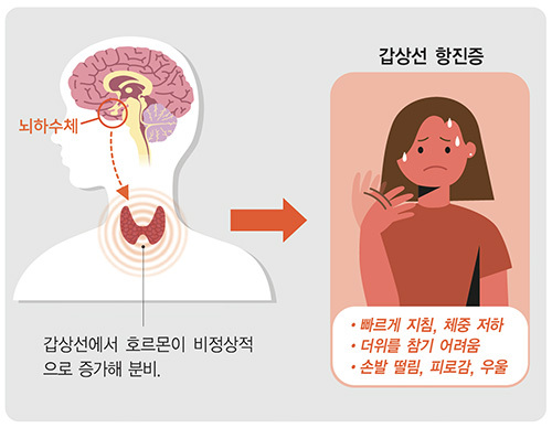 갑상샘기능항진증. /온라인커뮤니티