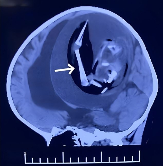 중국의 여자아이 두개골 속에서 발견된 쌍둥이 배아의 모습. /American Journal of Case Reports
