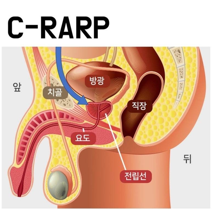 전립선 위치. 방광과 요도 사이에 호두만한 크기다. /가천길병원 블로그