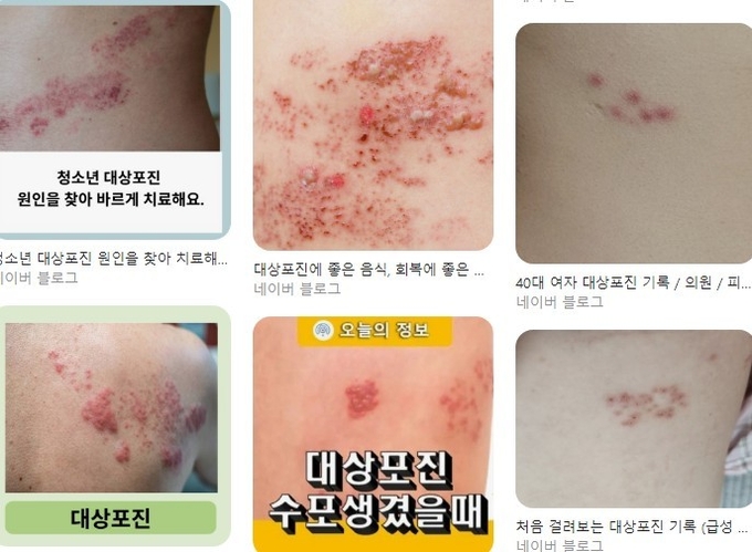 네이버에 올라온 대상포진 이미지들. 