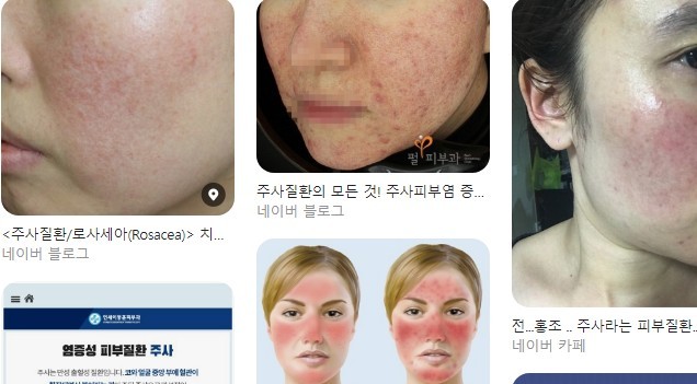 포털에 올라온 주사 질환 이야기들. /네이버