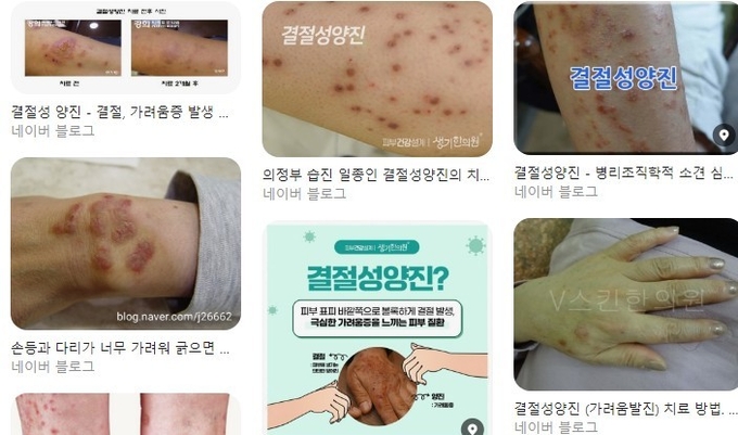 포털에 올라온 결절성 양진 관련 블로그. /네이버