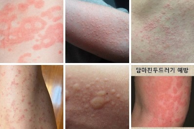 다양한 두드러기 증상들. /네이버 이미지