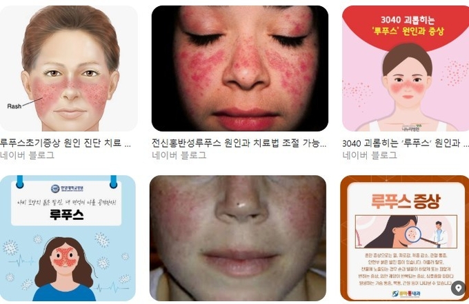 루푸스 증상들. /네이버이미지