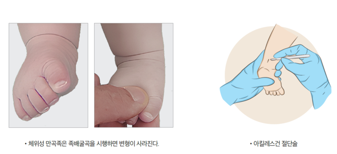 선천성 만곡족은 신생아나 영유아에게 나타나는 발 기형 중 하나로, 발생 빈도는 1000명당 약 1명 정도이다. 발이 안쪽으로 휘어진 상태를 말하며 흔히 내반족이라고도 부른다. 사진 | 더행복한건강생활