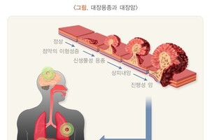 대장내시경 국가검진 도입될까