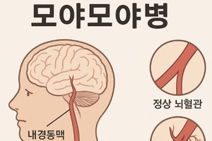 [이런 병, 저런 병] <41>순간적 두통과 마비 일으키는 모야모야병