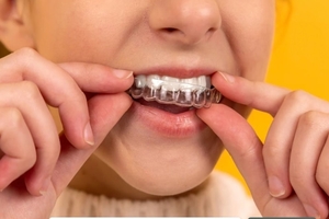 [궁금한 건강] <82>하얀 미소의 비밀, ‘치아 미백’