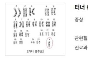 [이런 병, 저런 병] <46>염색체 이상 ‘터너 증후군’과 ‘클라인펠터 증후군’, 그리고 '인터섹스'