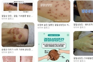 [이런 병, 저런 병] (50)피 날 때까지 긁는 ‘결절성 양진’