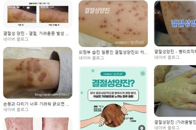 [이런 병, 저런 병] (50)피 날 때까지 긁는 ‘결절성 양진’