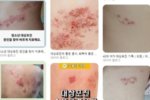 통증의 왕 '대상포진'의 모든 것