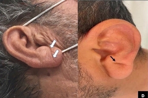 귓불에 생긴 대각선 주름...“심장 이상 징후일 수도”