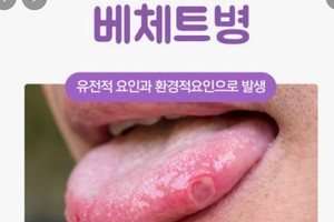 [이런 병, 저런 병] <55>구강 궤양 자주 생기면 ‘베체트병’일까?