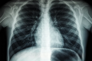 [건강칼럼] 증상 없는 위험, 잠복 결핵을 아시나요