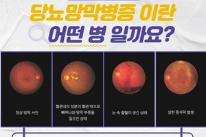 [이런 병, 저런 병] <56>당뇨망막증...실명을 부르는 침묵의 합병증